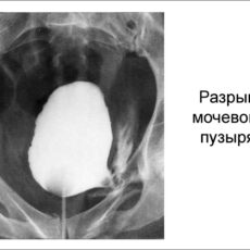 Доклад на тему: Разрыв мочевого пузыря