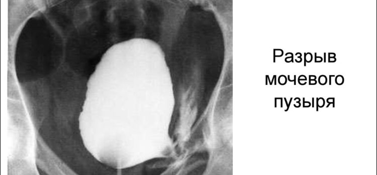 Доклад на тему: Разрыв мочевого пузыря